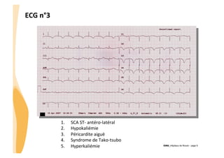 ECG	
  n°3	
  

1. 
2. 
3. 
4. 
5. 

SCA	
  ST-­‐	
  antéro-­‐latéral	
  
Hypokaliémie	
  
Péricardite	
  aiguë	
  
Syndrome	
  de	
  Tako-­‐tsubo	
  
Hyperkaliémie	
  

CHU_Hôpitaux de Rouen - page 9

 