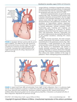 Copyright © Lippincott Williams  Wilkins. Unauthorized reproduction of this article is prohibited.
oxygen delivery, ventilation, hypothermia, acidosis,
depth of anesthesia and hypovolemia. It is generally
recommended that elective noncardiac procedures
be postponed until after the SCPA [17

,18

].
Post-Glenn haemodynamics are generally more
resilient (Fig. 2 [8]). The patient is still cyanotic with
a baseline saturation of around 85%, but the single
ventricle is now partially unloaded, as the systemic
venous return from the upper half of the body is
diverted directly to the pulmonary circulation. The
avoidance of hypovolemia remains important.
Pulmonary blood flow is dependent on maintaining
a normal pulmonary vascular resistance (PVR).
Hypercarbia, pain, vomiting and coughing can
increase PVR leading to a decrease in passive
pulmonary blood flow from the superior vena cava
(SVC) and hypoxemia. However, hypocarbia can
also lead to hypoxemia by decreasing the blood flow
to the cerebral circulation, reducing SVC return
[17

,18

].
After the Fontan procedure, the total cavopul-
monary anastomosis, all systemic venous return is
routed directly to the pulmonary arteries (Fig. 3 [8]).
Occasionally, a small fenestration in the Fontan
circuit provides a pop-off into the common atrium.
In the absence of a fenestration, the patient is
usually normally saturated, but cardiac output is
entirely dependent on passive blood flow through
the lungs. This reliance on passive pulmonary blood
flow reduces the relative stability of this stage of
palliation. When undergoing general anesthesia, it
Reconstructed
outflow from
right vetricle to
aortic pathways
Superior
cardiopulmonary
shunt
FIGURE 2. Hypoplastic left heart syndrome after the second
stage of palliation. The outflow from the right ventricle has
been reconstructed during a neonatal surgery. The superior
cavopulmonary anastomosis has been performed at age
3–6 months, a procedure that virtually all patients with a
single functional ventricle will undergo. Reproduced with
permission from [8].
FIGURE 3. Lateral tunnel Fontan (left) and extracardiac Fontan (right). In both configurations, there is no pulmonary (right)
ventricle. A total cavopulmonary connection is created where pulmonary blood flow depends on pressure gradient between
vena cavae, pulmonary artery and left atrium. Spontaneous ventilation augments this flow, whereas positive pressure
ventilation reduces the pressure gradient and can reduce pulmonary blood flow. A fenestration can be placed with either of
these configurations. Reproduced with permission from [8].
Anesthesia for noncardiac surgery Gottlieb and Andropoulos
0952-7907 ß 2013 Wolters Kluwer Health | Lippincott Williams  Wilkins www.co-anesthesiology.com 321
 