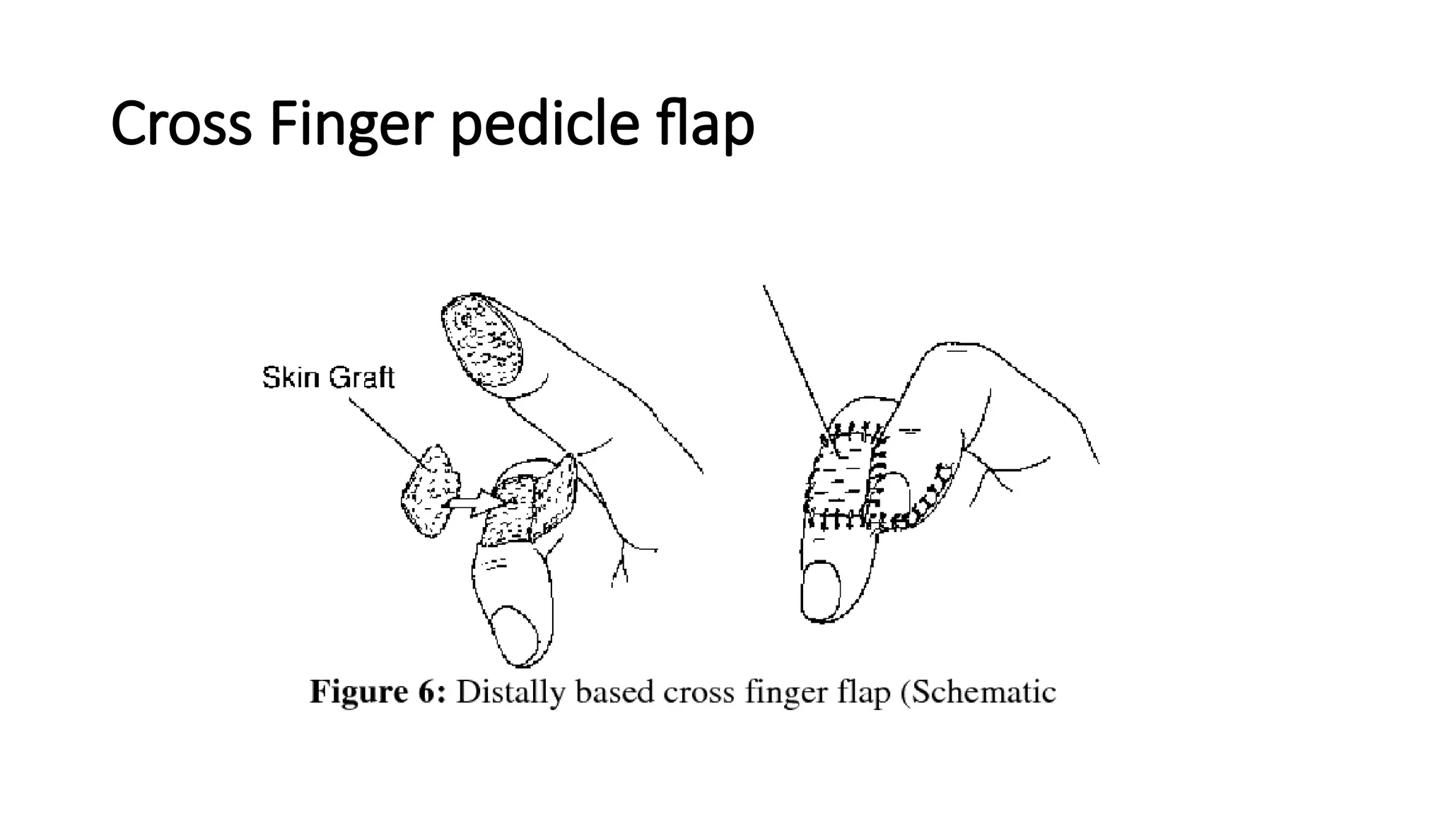 Cross Finger pedicle flap
 