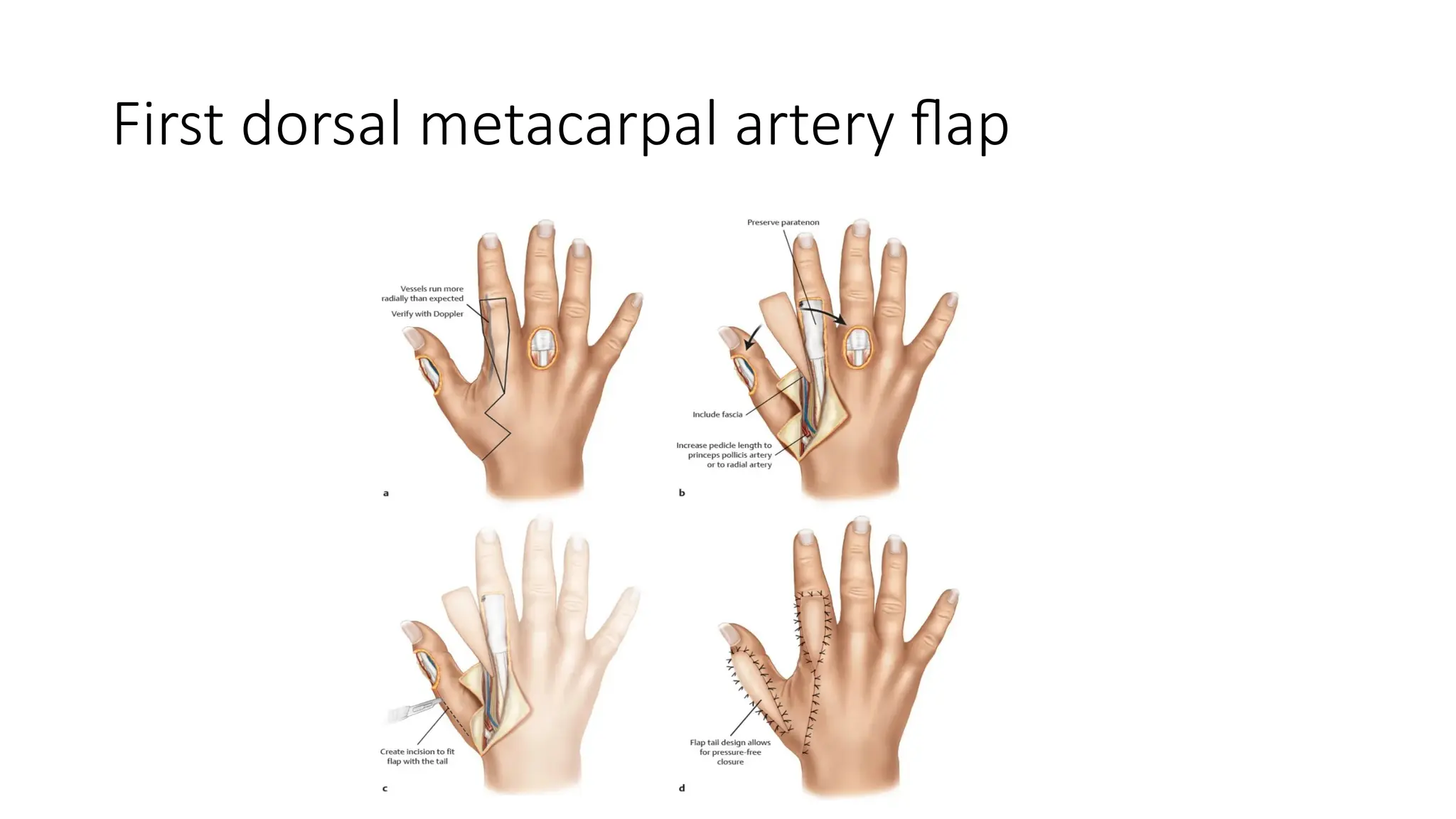 First dorsal metacarpal artery flap
 