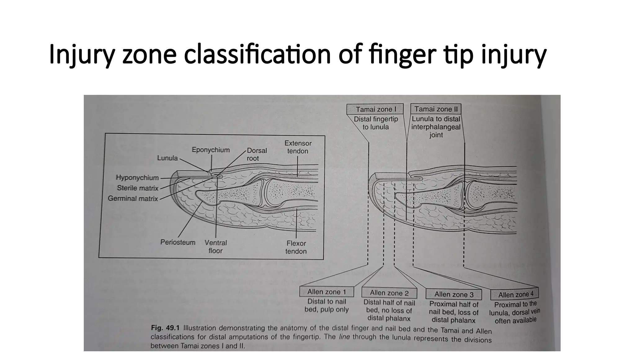 Injury zone classification of finger tip injury
 