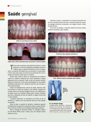 Reabilitação



Saúde gengival
                                                                                   Decorrido 4 meses, a colocação de um elemento provisório fora
                                                                               de suma importância pois esse teve o importante papel de manipu-
                                                                               lar a gengiva através de compressão, nas margens mesial e distal,
                                                                               durante 60 dias.
                                                                                   No termino do trabalho, o elemento definitivo fora feito metalo-
                                                                               cerâmica cimentada, sobre implante.




                  Dente 11 com fratura de raiz e fístula




                                                                                               Provisório sobre implante, elemento 11




Papila mesial e distal conformada através do provisório e perfil do implante




    T
           emos hoje uma grande necessidade de preservar a saúde
           gengival. Em casos da reabilitação odontológica através de
           implante ósseo, a papila interdentária tornou-se em alguns
casos, uma grande dificuldade para sua promoção ou preservação.
O clínico deve estar atento as estruturas do periodonto bem como o
espaço que devemos utilizar para um implante.
    Muitas vezes estamos atento ao comprimento que podemos
colocar um implante e deixamos sem muita importância o espaço                           Final - Metalo-cerâmica cimentado sobre implante
adjacentes entre os elemento. Poder contar com elemento dentário
adjacente aumenta em muito nossa previsibilidade de uma estética
satisfatória juntamente com o desejo do paciente, que tudo fique o
mais natural possível.
    Depois de estabelecermos normas de saúde, devemos estar                                                 Raio-X
muito atento ao modelo de implante a ser utilizado. Implantes de                                            implante
conexão interna, por exemplo Hexágono interno e com plataforma e                                            elemento
                                                                                                            11
em alguns casos com superfície tratada podem oferecer condições
para que a reabsorção ao redor do implante, na região cervical seja
o menor possível.
    A paciente apresentou no consultório com fratura de raiz no
elemento 11, devido a pino intra radicular Flex Post, muito utilizado
no passado.
    Antes de fazer a extração do elemento, instalamos aparelho                   Dr. Luís Henrique Vinagre
                                                                                 Cirurgião-dentista; Ministrador e Palestrante;
ortodôntico afim de promover a extrusão do mesmo, durante 60 dias,
                                                                                 Graduado pela Faculdade de Odontologia de
para minimizar os efeitos da remodelação óssea após exodontia.                   Lins; Pós graduado em Implante e Prótese; Se-
    Após a extração do elemento dentário, foi instalado implante                 cretário Estética APCD 2000 e 2002; Secretário
HI cone Morse CAPSA, após 3 meses, pois uma infecção crônica                     APCD Pirituba/Perus; Diretor Jornal ABO SP
estava em curso.


12 | APCD SAÚDE | JUL | AGO |SET | 2009
 