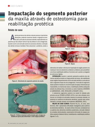 Caso Clínico



Impactação do segmento posterior
da maxila através de osteotomia para
reabilitação protética
Relato de caso


    A
           perda prematura dos dentes naturais provoca importantes
           alterações, podendo ocasionar desde a migração de den-
           tes até a extrusão do processo alveolar, especialmente em
paciente que não utilizam nenhum tipo de prótese no arco antagonista.
Quando ocorre uma extrusão severa do processo alveolar, a extração
dos dentes torna-se inevitável. Para solucionar o problema, existe a
                                                                                                     Figura C - Antes




                                                                                                    Figura D - Depois


                                                                        alternativa de realizar a técnica de impactação da região posterior da
                                                                        maxila por meio de osteotomia unilateral ou bilateral, para possibilitar
                                                                        uma futura reabilitação estética e funcional, sem a perda ou desgaste
                                                                        de estruturas hígidas.
                                                                             Introdução: Quando o paciente apresenta ausência dos ele-
                                                                        mentos dentários durante um longo período de tempo, não reabilitando
        Figura A - Osteotomia do segmento posterior da maxila           essas regiões frequentemente ocorre extrusão dentária ou extrusão de
                                                                        todo o segmento ósseo do arco antagonista. A extrusão do segmento
                                                                        ósseo posterior resulta em uma diminuição do espaço interoclusal que
                                                                        impossibilita, na maioria das vezes, a reabilitação protética adequada
                                                                        através de próteses fixas, removíveis ou sobre implantes (SHOEMAN
                                                                         SUBRAMANIAN, 1996; RENOUARD  RANGERT, 2001).
                                                                             A osteotomia segmentar posterior da maxila foi relatada pela
                                                                        primeira vez por STOKER  EPKER (1974) e tem sido utilizada como
                                                                        recurso na correção de extrusões severas do processo alveolar, na
                                                                        presença ou ausência de elementos dentários, quando esta contra-
                                                                        indicada à correção através mini-implantes (MEDEIROS, 2001).
                                                                             RELATO DO CASO CLÍNICO: Paciente M.L.O.L, 31 anos, sexo
                                                                        feminino, ASA I apresentava dificuldade mastigatória pela ausência
                                                                        de elementos dentários. Ao exame clínico intra-oral, constataram-se
                                                                        a ausência dos elementos dentários posteriores, extrusão bilateral
                                                                        do complexo dento-alveolar, ocasionando diminuição do espaço pro-
    Figura B - Prótese removível confeccionada após cirurgia nos
                                                                        tético posterior bilateral inferior, inviabilizando a reabilitação protética
     modelos de gesso para determinar o novo espaço protético           (figuras C e E).



 | APCD SAÚDE | JUL | AGO |SET | 2009
 