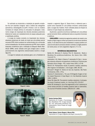 Foi solicitado ao ortodontista a instalação de aparelho ortodôn-    impactar o segmento (figura A). Dessa forma, e referencia para o
tico fixo com esporões cirúrgicos. Após a análise das radiografias       quanto seria impactado foi uma prótese removível, confeccionada
(panorâmica, teleradiografia de perfil e frontal) e com os modelos       após a cirurgia dos modelos. Foram utilizadas placas de fixação do
montados em relação cêntrica no articulador, foi planejado o trata-      sistema 2.0 para fixação das osteotomias.
mento cirúrgico de impactação dos rebordos alveolares posteriores            Atualmente a paciente encontra-se reabilitada com uma prótese
bilateral de maxila com restabelecimento do espaço adequado para         parcial removível inferior, satisfazendo todos os requisitos funcionais
a reabilitação protética.                                                e estéticos.
     A cirurgia de modelo consistiu na impactação dos rebordos               CONCLUSÕES: A osteotomia segmentar posterior da maxila é uma
alveolares posteriores de maxila, de modo que uma prótese parcial        terapia cirúrgica segura e eficaz que preserva as estruturas dentárias
removível (PPR) inferior pudesse ser confeccionada com a dimensão        sadias. O uso desta técnica para restabelecer o espaço protético em
vertical restabelecida. Aos dentes posteriores da PPR, foram colados     casos de extrusão do processo alveolar e dentário na região posterior
bráquetes ortodônticos para a realização do Bloqueio Maxilo Man-         da maxila possui um bom prognóstico (figuras E, F, C e D).
dibular (BMM), sendo utilizada como guia cirúrgico para o correto
posicionamento dos segmentos osteotomizados durante a cirurgia                              REFERÊNCIAS BIBLIOGRÁFICAS
(figura B).                                                              Beltrão GC, Weismann R, Santana Filho M. Osteotomia - Maxila e
     A cirurgia foi realizada sob anestesia geral, com a finalidade de   Mandíbula fins protéticos-ortodônticos. Rev Odonto Ciênc 1992;
                                                                         7(14):167-75.
                                                                         Laboissiére Jr M, Villela H, Bezerra F, Laboissiére M, Diaz L. Ancora-
                                                                         gem absoluta utilizando microparafusos ortodônticos: Protocolo para
                                                                         aplicação clínica (trilogia – Pt2). Implant News 2005; 2:37-46.
                                                                         Martins CH. Postoperative results of posterior maxillary osteotomy
                                                                         after long-term immobilization. J Oral Surgery 1980; 38:103.
                                                                         Renouard F, Rangert B. Fatores de risco dos implantes. São Paulo:
                                                                         Quintessense, 2001. 176 p.
                                                                         Shoeman R, Subramanian L. The use of Orthognatic Surgery to faci-
                                                                         lite Implant Placement: A Case Report. Int J Oral Maxillofac Implants
                                                                         1996; 11:682-4.
                                                                         Stoker NG, Epker BN. The posterior maxillary osteotomy: A retrospes-
                                                                         tive study of treatment results. Int J Oral Surg 1974; 33:153-7.
                                                                         Stuller CB, Schaberg SJ. Use of the segmented Le Fort I osteotomy to
                          Figura E - Antes                               correct severe extrusion of maxillary posterior teeth or tuberosities.
                                                                         The Journal Of Prosthetic Dentistry 1983;50:157. 1983.




                                                                           Gustavo Henrique Motta
                                                                           Especialista em Cirurgia e Traumatologia
                                                                           Buco MaxiloFacial; Prof. Cirurgia Avançada
                                                                           AOL; Prof. Deformidade dentofacial Unip;
                                                                           Implantodontia; Clínica Privada de Cirurgia
                                                                           Ortognática


                                                                           Aluisio Galeano, Octavio Margoni e Marcos Pitta
                                                                           Especialistas em Cirurgia Ortognática pela Baylor University/EUA
                          Figura F - Depois




                                                                                                               APCD SAÚDE | JUL | AGO |SET | 2009 | 
 