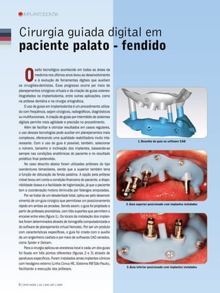 Implantodontia



Cirurgia guiada digital em
paciente palato - fendido

    O
             salto tecnológico acontecido em todas as áreas da
             medicina nos últimos anos levou ao desenvolvimento
             e à evolução de ferramentas digitais que auxiliam
os cirurgiões-dentistas. Esse progresso ocorre por meio de
planejamentos cirúrgicos virtuais e da criação de guias estereo-
litografados na implantodontia, entre outras aplicações, como
na prótese dentária e na cirurgia ortognática.
     O uso de guias em implantodontia é um procedimento utiliza-
do com freqüência, sejam cirúrgicos, radiográficos, diagnósticos
ou multifuncionais. A criação de guias por intermédio de sistemas
digitais permite mais agilidade e precisão no procedimento.
     Além de facilitar e otimizar resultados em casos regulares,
o uso dessas tecnologias pode auxiliar em planejamentos mais
complexos, oferecendo uma qualidade reabilitadora muito inte-
                                                                              1. Desenho do guia no software CAD
ressante. Com o uso do guia é possível, também, selecionar
o número, tamanho e inclinação dos implantes, baseando-se
sempre nas condições anatômicas do paciente e no resultado
protético final pretendido.
     No caso descrito abaixo foram utilizadas próteses do tipo
overdentures bimaxilares, sendo que a superior também teria
a função de obturação da fenda palatina. A opção pela prótese
móvel levou em conta a condição financeira do paciente, a dispo-
nibilidade óssea e a facilidade de higienização, já que o paciente
tem a coordenação motora diminuída por falanges amputadas.
     Por se tratar de um desdentado total, optou-se pelo desenvol-
vimento de um guia cirúrgico que permitisse um posicionamento
                                                                      2. Guia superior posicionado com implantes instalados
rápido em ambas as arcadas. Sendo assim, o guia foi projetado a
partir de próteses provisórias, com três suportes que permitem o
encaixe entre eles (figura 1). Os locais da instalação dos implan-
tes foram determinados através de tomografia computadorizada e
do software de planejamento virtual Nemotec. Por ser um produto
com características específicas, o guia foi criado com o auxílio
de um engenheiro cadista e por meio de softwares CAD variados,
como Spider e Delcam.
     Para a cirurgia aplicou-se anestesia local e cada um dos guias
foi fixado em três pontos diferentes (figuras 2 e 3) através de
parafusos específicos. Foram instalados ainda implantes cônicos
com hexágono externo (Linha Conus HE, Sistema INP São Paulo),
                                                        ,
                                                                      3. Guia inferior posicionado com implantes instalados
facilitando a execução das próteses.



 | APCD SAÚDE | JUL | AGO |SET | 2009
 