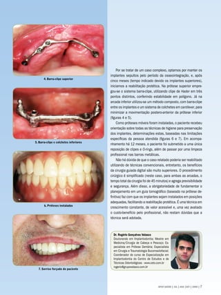Por se tratar de um caso complexo, optamos por manter os
                                        implantes sepultos pelo período da osseointegração, e, após
      4. Barra-clipe superior
                                        cinco meses (tempo indicado devido os implantes superiores),
                                        iniciamos a reabilitação protética. Na prótese superior empre-
                                        gou-se o sistema barra-clipe, utilizando clipe de Hader em três
                                        pontos distintos, conferindo estabilidade em polígono. Já na
                                        arcada inferior utilizou-se um método composto, com barra-clipe
                                        entre os implantes e um sistema de colchetes em cantilever, para
                                        minimizar a movimentação postero-anterior da prótese inferior
                                        (figuras 4 e 5).
                                             Como próteses móveis foram instaladas, o paciente recebeu
                                        orientação sobre todas as técnicas de higiene para preservação
                                        dos implantes, determinações estas, baseadas nas limitações
                                        específicas da pessoa atendida (figuras 6 e 7). Em acompa-
5. Barra-clipe e colchetes inferiores
                                        nhamento há 12 meses, o paciente foi submetido a uma única
                                        reposição de clipes e O-rings, além de passar por uma limpeza
                                        profissional nas barras metálicas.
                                             Não há dúvida de que o caso relatado poderia ser reabilitado
                                        utilizando de técnicas convencionais, entretanto, os benefícios
                                        da cirurgia guiada digital são muito superiores. O procedimento
                                        cirúrgico é simplificado (neste caso, para ambas as arcadas, o
                                        tempo total da cirurgia foi de 45 minutos) e agrega previsibilidade
                                        e segurança. Além disso, a obrigatoriedade de fundamentar o
                                        planejamento em um guia tomográfico (baseado na prótese de-
                                        finitiva) faz com que os implantes sejam instalados em posições
                                        adequadas, facilitando a reabilitação protética. É uma técnica em
       6. Próteses instaladas
                                        crescimento constante, de valor acessível e, uma vez avaliado
                                        o custo-benefício pelo profissional, não restam dúvidas que a
                                        técnica será adotada.



                                          Dr. Rogério Gonçalves Velasco
                                          Doutorando em Implantodontia; Mestre em
                                          Medicina/Cirurgia de Cabeça e Pescoço; Es-
                                          pecialista em Prótese Dentária; Especialista
                                          em Cirurgia e Traumatologia Bucomaxilofacial;
                                          Coordenador do curso de Especialização em
                                          Implantodontia do Centro de Estudos e de
                                          Técnicas Odontológicas - www.ceto.com.br
                                          rogerio@grupovelasco.com.br
  7. Sorriso forçado do paciente




                                                                              APCD SAÚDE | JUL | AGO |SET | 2009 | 
 