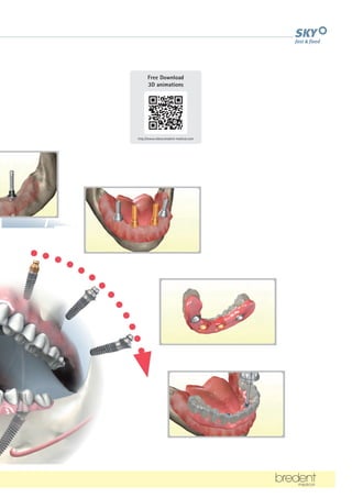 3
12
http://www.videos.bredent-medical.com
Free Download
3D animations
 