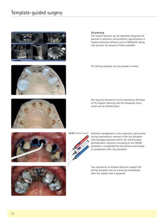 22
Template-guided surgery
HELBO TheraLite Laser®
3D planning
The implant position can be optimally designed and
planned to aesthetic and prosthetic specifications in
implant planning software such as SKYplanX, taking
into account the amount of bone available.
The drilling template can be pressed or milled.
The required abutments can be selected on the basis
of the implant planning and the temporary resto-
ration can be prefabricated.
Infection management is also important, particularly
during simultaneous removal of the last periodon-
tally damaged abutment teeth. The antimicrobial
photodynamic treatment according to the HELBO
procedure is established for disinfection and analge-
sic prophylaxis after the procedure.
Four abutments of residual dentition support the
drilling template and are extracted immediately
after the implant bed is prepared.
 