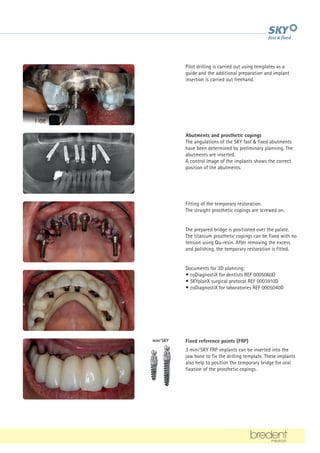 Pilot drilling is carried out using templates as a
guide and the additional preparation and implant
insertion is carried out freehand.
Abutments and prosthetic copings
The angulations of the SKY fast  fixed abutments
have been determined by preliminary planning. The
abutments are inserted.
A control image of the implants shows the correct
position of the abutments.
Fitting of the temporary restoration.
The straight prosthetic copings are screwed on.
The prepared bridge is positioned over the palate.
The titanium prosthetic copings can be fixed with no
tension using Qu-resin. After removing the excess
and polishing, the temporary restoration is fitted.
Documents for 3D planning:
• coDiagnostiX for dentists REF 0005060D
• SKYplanX surgical protocol REF 0003910D
• coDiagnostiX for laboratories REF 0005040D
Fixed reference points (FRP)
3 mini1
SKY FRP implants can be inserted into the
jaw bone to fix the drilling template. These implants
also help to position the temporary bridge for oral
fixation of the prosthetic copings.
mini1
SKY
 
