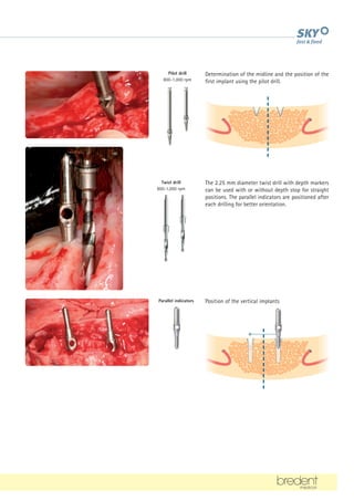 Pilot drill
800-1,000 rpm
Position of the vertical implants
Parallel indicators
Twist drill
800-1,000 rpm
The 2.25 mm diameter twist drill with depth markers
can be used with or without depth stop for straight
positions. The parallel indicators are positioned after
each drilling for better orientation.
Determination of the midline and the position of the
first implant using the pilot drill.
 