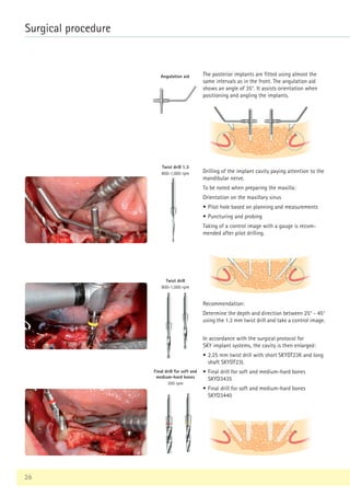 26
Surgical procedure
The posterior implants are fitted using almost the
same intervals as in the front. The angulation aid
shows an angle of 35°. It assists orientation when
positioning and angling the implants.
Twist drill
800-1,000 rpm
Drilling of the implant cavity paying attention to the
mandibular nerve.
To be noted when preparing the maxilla:
Orientation on the maxillary sinus
•	
Pilot hole based on planning and measurements
• Puncturing and probing
Taking of a control image with a gauge is recom-
mended after pilot drilling.
Recommendation:
Determine the depth and direction between 25° - 45°
using the 1.3 mm twist drill and take a control image.
In accordance with the surgical protocol for
SKY implant systems, the cavity is then enlarged:
•	
2.25 mm twist drill with short SKYDT23K and long
shaft SKYDT23L
•	
Final drill for soft and medium-hard bones
SKYD3435
•	
Final drill for soft and medium-hard bones
SKYD3440
Angulation aid
Twist drill 1.3
800-1,000 rpm
Final drill for soft and
medium-hard bones
300 rpm
 