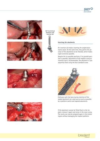 Inserting the abutments
An insertion aid makes inserting the angled abut-
ments easier. At the same time, they permit the po-
sition of the abutments to be checked, which makes
rapid correction possible.
Despite the six possible positions, if no parallel posi-
tion is possible, adjustment of the implant using an
insertion tool is recommended. The abutment is sub-
sequently fixed using the blue standard screw.
SKY fast  fixed
abutment with
insertion aid
If the abutment cannot be fitted flush to the im-
plant, remove it again and screw in the cover screw.
The cavity can now be prepared again in the crestal
region without damaging the implant platform.
Collisions with the bone during insertion of the
angled abutment are ruled out as much as possible
by a platform switch and tapered abutments.
 
