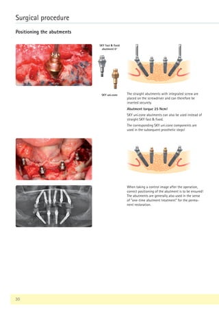30
Surgical procedure
Positioning the abutments
The straight abutments with integrated screw are
placed on the screwdriver and can therefore be
inserted securely.
Abutment torque 25 Ncm!
SKY uni.cone abutments can also be used instead of
straight SKY fast  fixed.
The corresponding SKY uni.cone components are
used in the subsequent prosthetic steps!
SKY fast  fixed
abutment 0°
SKY uni.cone
When taking a control image after the operation,
correct positioning of the abutment is to be ensured!
The abutments are generally also used in the sense
of one-time abutment treatment for the perma-
nent restoration.
 