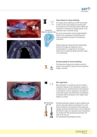 breciform D
Single-use impression tray
SKY fast  fixed
open tray
Snap copings for closed modelling
For simple, quick modelling, the SKY fast  fixed
or SKY uni.cone snap copings are pressed onto
the abutments with a precision groove. When the
impression is removed, the copings remain in the
impression due to retention wings.
Any minor inaccuracies can be compensated for
thanks to the subsequent oral bonding of the
titanium prosthetic copings to the temporary
restoration.
Screwed copings for closed modelling
The impression copings are screwed in and can
remain in the patient's mouth until the temporary
bridge is inserted.
Bite registration
Bite registration is carried out over the screwed
impression copings or bite registration copings. A
mushbite prior to commencement of the operation
is compulsory. It can be supported in the palate or
in the tuber region and relined after the operation.
A mushbite after articulation of the model is also
helpful as a check.
Screwed impression copings for open modelling can
also be used when taking an impression for a tem-
porary restoration. The positions of the impression
copings can be determined thanks to the transparent
breciform D single-use impression tray. The positions
are marked and then perforated by grinding. The
edge of the tray can
be customised using kneading silicone.
Closed impression taking with the customisable
breciform D single-use impression tray is
recommended. It is important for the dental
technician to include the palate and tuber region
in the impression.
 