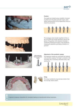 In general, temporary restorations for immediate loading are manufactured without extensions.
Creation
The models are created using a mushbite. A second
mushbite over the palate and tuber region, taken
before commencement of the implantation serves to
check the articulation.
Adjustment of the prosthetic copings
The impression copings are unscrewed and replaced
with prosthetic copings. The height is checked in the
articulator and, if necessary, shortened using a sep-
arating disc.
Setup
The setup is produced using novo.lign veneers from
the visio.lign veneer system.
SKY fast  fixed
titanium prosthetic
coping
The analogues stand straight regardless of the an-
gle of the SKY fast  fixed abutments used for the
patient. The position of the abutment shoulder is
transferred. Changing the angle is only possible by
changing the abutment and taking of another im-
pression!
 