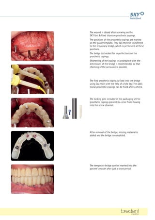 The wound is closed after screwing on the
SKY fast  fixed titanium prosthetic copings.
The positions of the prosthetic copings are marked
on the guide template. They can then be transferred
to the temporary bridge, which is perforated at these
positions.
The bridge is checked for imperfections on the
prosthetic copings.
Shortening of the copings in accordance with the
dimensions of the bridge is recommended so that
checking of the occlusion is possible.
The first prosthetic coping is fixed into the bridge
using Qu-resin with the help of a bite key. The addi-
tional prosthetic copings can be fixed after a check.
The locking pins included in the packaging set for
prosthetic copings prevent Qu-resin from flowing
into the screw channel.
After removal of the bridge, missing material is
added and the bridge is completed.
The temporary bridge can be inserted into the
patient's mouth after just a short period.
 