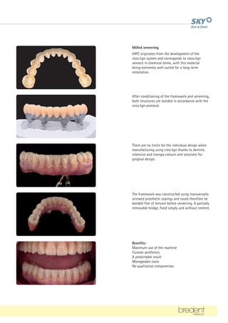 Milled veneering
HIPC originates from the development of the
visio.lign system and corresponds to novo.lign
veneers in chemical terms, with this material
being extremely well-suited for a long-term
restoration.
After conditioning of the framework and veneering,
both structures are bonded in accordance with the
visio.lign protocol.
There are no limits for the individual design when
manufacturing using crea.lign thanks to dentine,
intensive and transpa colours and solutions for
gingival design.
The framework was constructed using transversally
screwed prosthetic copings and could therefore be
bonded free of tension before veneering. A partially
removable bridge, fixed simply and without cement.
Benefits:
Maximum use of the machine
Custom aesthetics
A predictable result
Manageable costs
No qualitative compromises
 