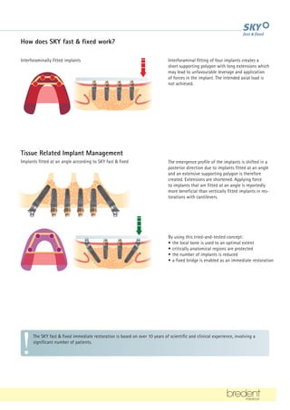 How does SKY fast  fixed work?
The SKY fast  fixed immediate restoration is based on over 10 years of scientific and clinical experience, involving a
significant number of patients.
Interforaminal fitting of four implants creates a
short supporting polygon with long extensions which
may lead to unfavourable leverage and application
of forces in the implant. The intended axial load is
not achieved.
By using this tried-and-tested concept:
• the local bone is used to an optimal extent
• critically anatomical regions are protected
• the number of implants is reduced
• a fixed bridge is enabled as an immediate restoration
Interforaminally fitted implants
The emergence profile of the implants is shifted in a
posterior direction due to implants fitted at an angle
and an extensive supporting polygon is therefore
created. Extensions are shortened. Applying force
to implants that are fitted at an angle is reportedly
more beneficial than vertically fitted implants in res-
torations with cantilevers.
Tissue Related Implant Management
Implants fitted at an angle according to SKY fast  fixed
 