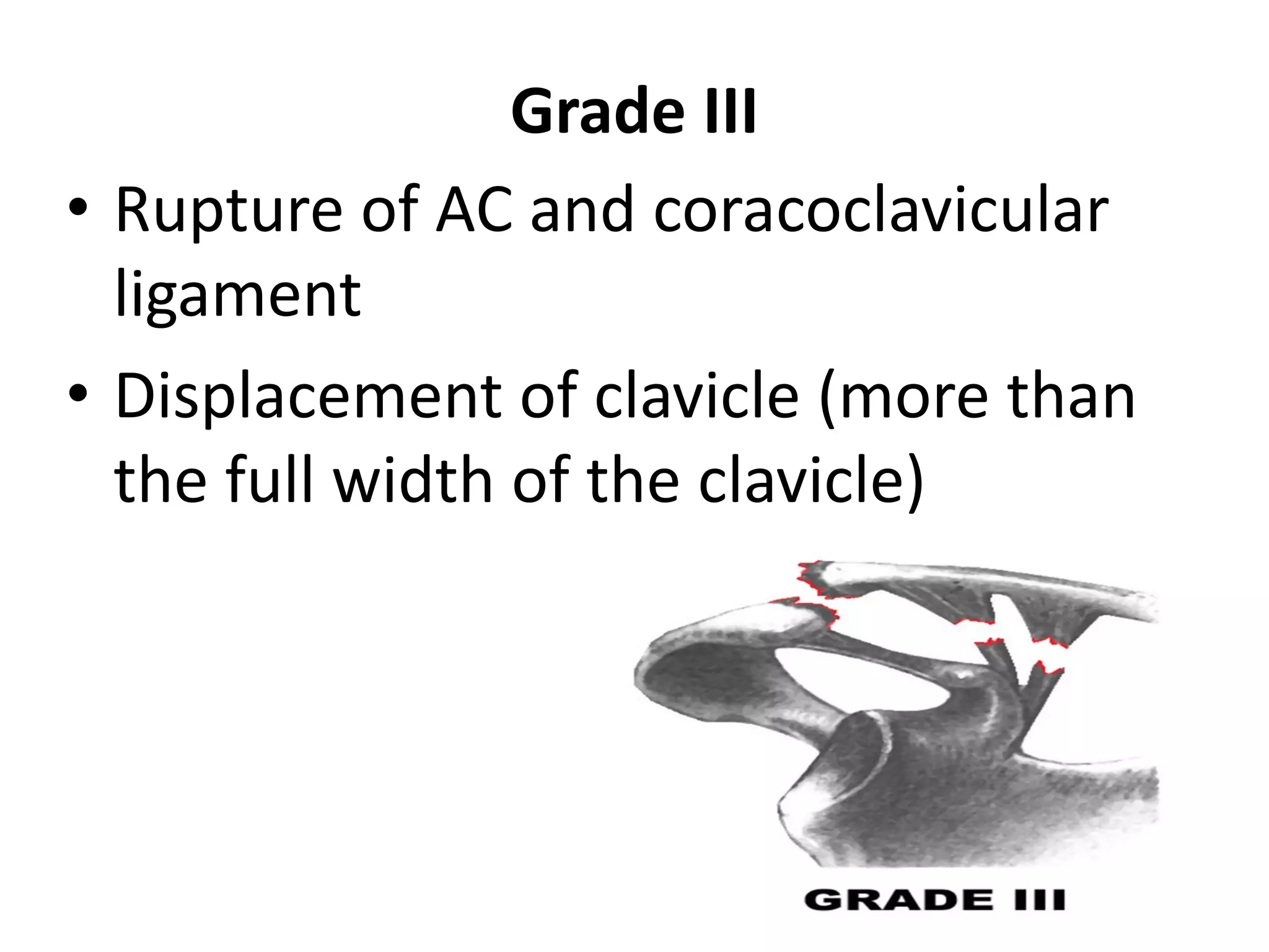 Grade III
• Rupture of AC and coracoclavicular
ligament
• Displacement of clavicle (more than
the full width of the clavicle)
 