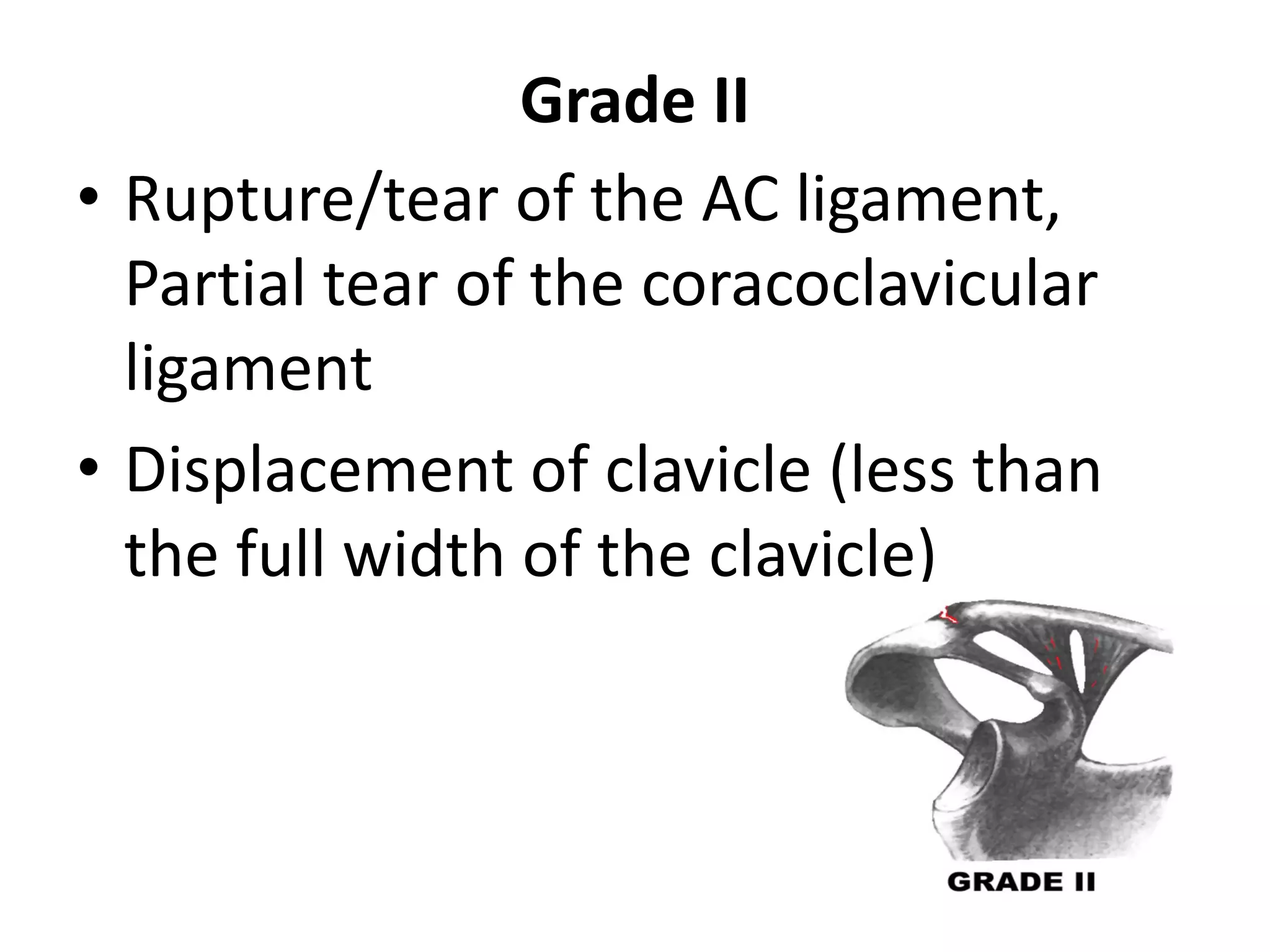 Grade II
• Rupture/tear of the AC ligament,
Partial tear of the coracoclavicular
ligament
• Displacement of clavicle (less than
the full width of the clavicle)
 