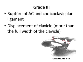Grade III
• Rupture of AC and coracoclavicular
ligament
• Displacement of clavicle (more than
the full width of the clavicle)
 