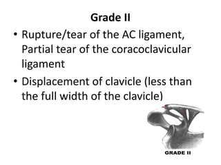 Grade II
• Rupture/tear of the AC ligament,
Partial tear of the coracoclavicular
ligament
• Displacement of clavicle (less than
the full width of the clavicle)
 