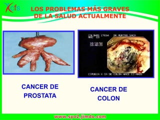 CANCER DE
PROSTATA
CANCER DE
COLON
LOS PROBLEMAS MÁS GRAVES
DE LA SALUD ACTUALMENTE
 