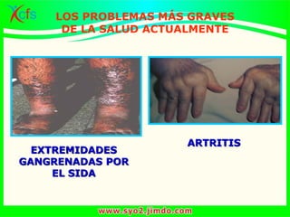 EXTREMIDADES
GANGRENADAS POR
EL SIDA
ARTRITIS
LOS PROBLEMAS MÁS GRAVES
DE LA SALUD ACTUALMENTE
 