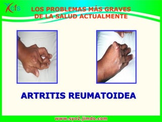 ARTRITIS REUMATOIDEA
LOS PROBLEMAS MÁS GRAVES
DE LA SALUD ACTUALMENTE
 