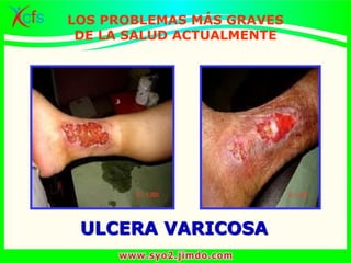 ULCERA VARICOSA
LOS PROBLEMAS MÁS GRAVES
DE LA SALUD ACTUALMENTE
 