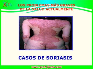CASOS DE SORIASIS
LOS PROBLEMAS MÁS GRAVES
DE LA SALUD ACTUALMENTE
 
