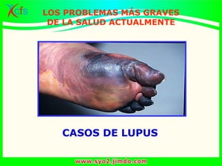 CASOS DE LUPUS
LOS PROBLEMAS MÁS GRAVES
DE LA SALUD ACTUALMENTE
 