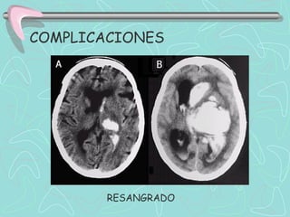 COMPLICACIONES




        RESANGRADO
 