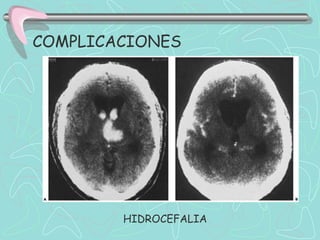 COMPLICACIONES




        HIDROCEFALIA
 