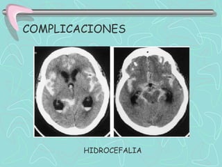 COMPLICACIONES




        HIDROCEFALIA
 