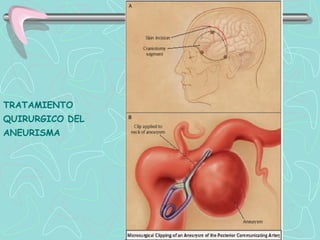 TRATAMIENTO
QUIRURGICO DEL
ANEURISMA
 