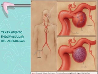 TRATAMIENTO
ENDOVASCULAR
DEL ANEURISMA
 