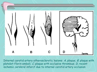 Internal carotid artery atherosclerotic lesions: A, plaque; B, plaque with
platelet-fibrin emboli; C, plaque with occlusive thrombus; D, recent
ischemic cerebral infarct due to internal carotid artery occlusion
 