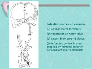 Potential sources of embolism
(a) cardiac mural thrombus
(b) vegetation on heart valve
(c) emboli from carotid plaque
(d) infarcted cortex in area
supplied by terminal anterior
cerebral art due to embolism
 