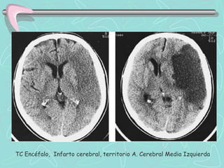 TC Encéfalo, Infarto cerebral, territorio A. Cerebral Media Izquierda
 