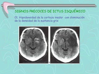 SIGNOS PRECOCES DE ICTUS ISQUÉMICO
01. Hipodensidad de la corteza insular con disminución
de la densidad de la sustancia gris
 
