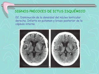 SIGNOS PRECOCES DE ICTUS ISQUÉMICO
02. Disminución de la densidad del núcleo lenticular
derecha. Infarto en putamen y brazo posterior de la
cápsula interna
 