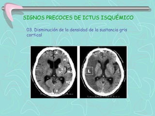 SIGNOS PRECOCES DE ICTUS ISQUÉMICO

 03. Disminución de la densidad de la sustancia gris
 cortical
 