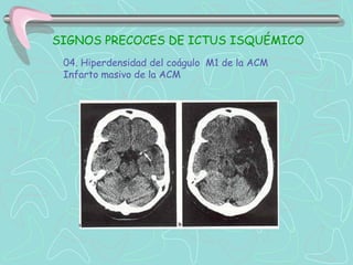 SIGNOS PRECOCES DE ICTUS ISQUÉMICO
 04. Hiperdensidad del coágulo M1 de la ACM
 Infarto masivo de la ACM
 