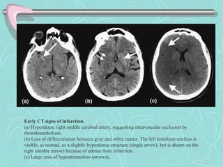 Early CT signs of infarction.
(a) Hyperdense right middle cerebral artery, suggesting intravascular occlusion by
thromboembolism.
(b) Loss of differentiation between gray and white matter. The left lentiform nucleus is
visible, as normal, as a slightly hyperdense structure (single arrow), but is absent on the
right (double arrow) because of edema from infarction.
(c) Large area of hypoattenuation (arrows),
 