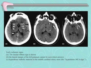 Early ischemic signs.
(a). The insular ribbon sign is shown
(b) the lateral margin of the left putamen cannot be seen (short arrows).
(c) hyperdense embolic material in the middle cerebral artery stem (the ‘‘hyperdense MCA sign,’’).
 