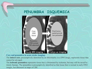 PENUMBRA ISQUEMICA




Core and penumbra in acute stroke imaging.
The infarct core, presumptively identified by an abnormality in a DWI image, represents tissue that
cannot be salvaged.
The ischemic penumbra represents tissue that is threatened by ischemia, but may still be saved by
timely therapy. The penumbra is presumptively identified as that tissue that is normal in early DWI
images, but abnormal in maps of CBF.
 