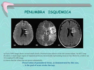 PENUMBRA ISQUEMICA




(a) Early DWI image shows several small closely clustered acute infarcts in the left corona radiata. An MTT map
(b) shows a much larger region of impaired perfusion, theoretically representing tissue at risk. However, a follow-up
T2-weighted FLAIR image
(c) shows that the infarct has not grown substantially.
                         Preservation of penumbral tissue, as demonstrated by this case,
                         … is the goal of acute stroke therapy.
 