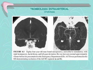 TROMBOLISIS INTRAARTERIAL
         Urokinasa
 