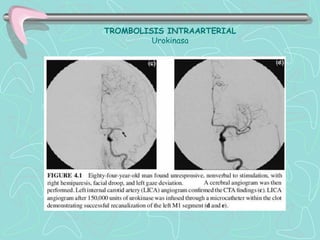 TROMBOLISIS INTRAARTERIAL
         Urokinasa
 